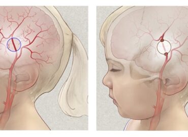 surgery-for-moyamoya-780x350