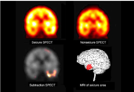 Pinpointing seizure location